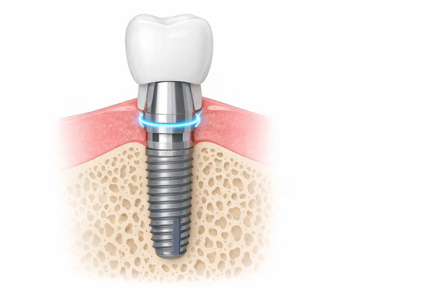A fogászati implantátum felépítmény ápolása: a láthatatlan kapocs egészsége